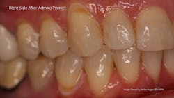 Figure 4: Patent's right side after Admira Protect treatment completed. Note whitish areas are a result of the coagulation of proteins and will be reversed within 48 hours after application. Figure 4: Patent's right side after Admira Protect treatment completed. Note whitish areas are a result of the coagulation of proteins and will be reversed within 48 hours after application.