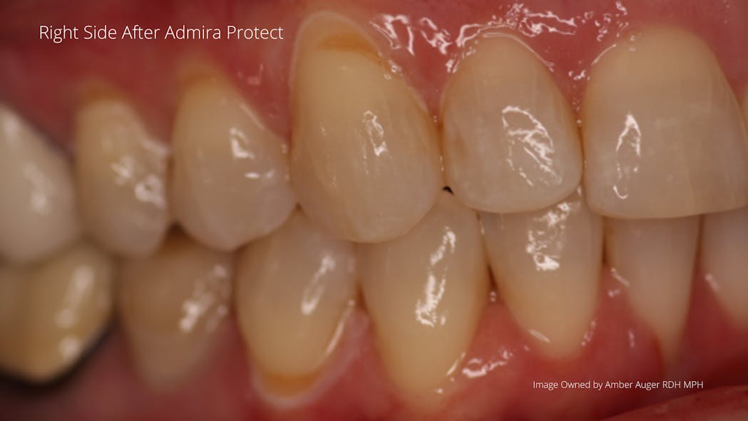 Figure 4: Patent&apos;s right side after Admira Protect treatment completed. Note whitish areas are a result of the coagulation of proteins and will be reversed within 48 hours after application.