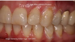 Figure 5: Patient's left side after Admire Protect completed. Note whitish areas result from the coagulation of proteins and will be reversed within 48 hours after application. Figure 5: Patient's left side after Admire Protect completed. Note whitish areas result from the coagulation of proteins and will be reversed within 48 hours after application.