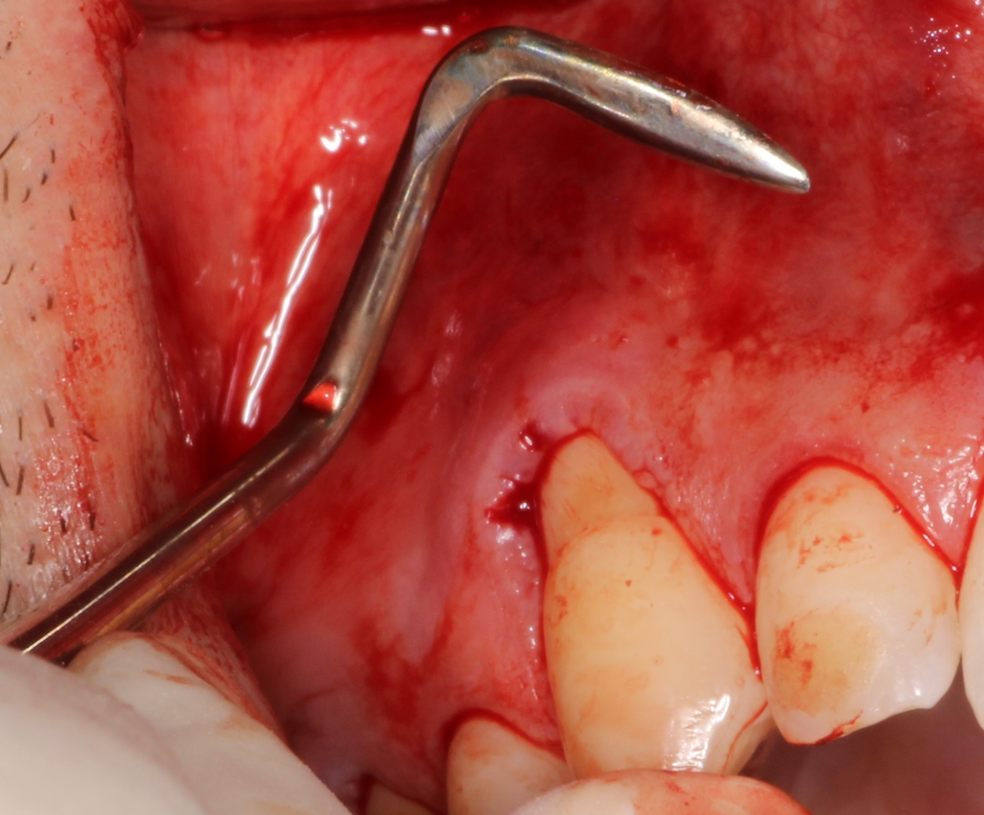 Pinhole Surgical Technique: A 10-year evaluation of root coverage ...