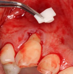 Figure 3: Bio-Gide collagen strips inserted into the pinhole incision Figure 3: Bio-Gide collagen strips inserted into the pinhole incision
