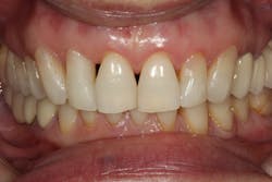 Figure 4: Advanced recession case with hard- and soft-tissue loss Figure 4: Advanced recession case with hard- and soft-tissue loss