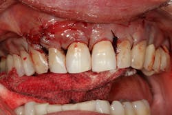 Figure 5: PST surgery using hard- and soft-tissue grafting and sutures Figure 5: PST surgery using hard- and soft-tissue grafting and sutures