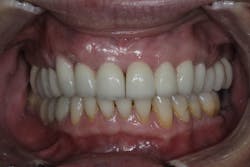 Figure 6: Stable result two years after PST and cosmetic dentistry Figure 6: Stable result two years after PST and cosmetic dentistry