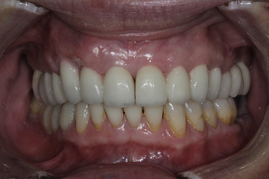 Figure 6: Stable result two years after PST and cosmetic dentistry