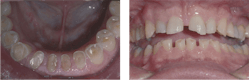 Figure 1: Among the most frequently identified reasons for implant failure is occlusion. These images show grinding and clenching bruxism for which implant-supported prostheses would require meticulous planning and procedures for success.