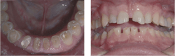 Figure 1: Among the most frequently identified reasons for implant failure is occlusion. These images show grinding and clenching bruxism for which implant-supported prostheses would require meticulous planning and procedures for success. Figure 1: Among the most frequently identified reasons for implant failure is occlusion. These images show grinding and clenching bruxism for which implant-supported prostheses would require meticulous planning and procedures for success.