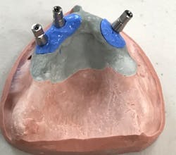 Figure 4: What can be done with this clinical situation? This patient has inadequately located and inclined implants. He could be treated by placing a bar and clip prosthesis, but even that would place unpredictable stress on the underlying implants. Figure 4: What can be done with this clinical situation? This patient has inadequately located and inclined implants. He could be treated by placing a bar and clip prosthesis, but even that would place unpredictable stress on the underlying implants.