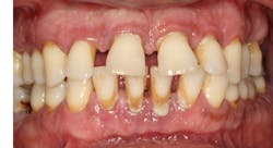 Figure 5: If some of these periodontally diseased teeth needed to be extracted, conventional dentistry would probably be better since the organisms causing the periodontal disease and remaining in the mouth have high potential to stimulate peri-implantitis.