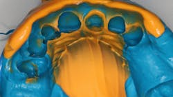 Figure 1: Impression for a single anterior crown and an upper partial Figure 1: Impression for a single anterior crown and an upper partial