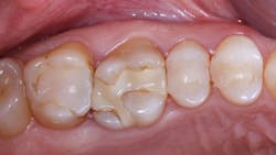 Figure 1: What has caused these composite restorations to degenerate? The patient says they had been in her mouth only a short time. Many factors cause this challenge&mdash;operator error, composite shrinkage, material properties, and many other reasons discussed in this article.