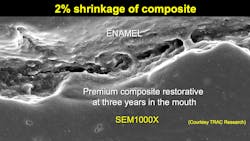 Figure 2: When observing composite resin restorations at 1,000 X, all of them have wide-open margins that allow ingress of oral fluids and microbes. Figure 2: When observing composite resin restorations at 1,000 X, all of them have wide-open margins that allow ingress of oral fluids and microbes.