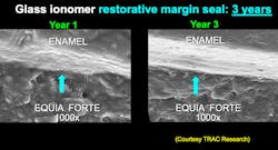 Figure 3: The new conventional glass ionomers provide an actual seal of restoration margins as well as fluoride release. Figure 3: The new conventional glass ionomers provide an actual seal of restoration margins as well as fluoride release.