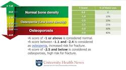 Figure 3: Osteopenia and osteoporosis are often overlooked in diagnostic procedures. Poor bone density has a guarded potential for implant placement.