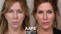 Figure 1: Botox, fillers, and PDO threads rejuvenated this patient&rsquo;s lip lines and smile lines for much improved facial esthetics.