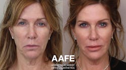 Figure 1: Botox, fillers, and PDO threads rejuvenated this patient&rsquo;s lip lines and smile lines for much improved facial esthetics.