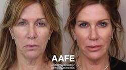 Figure 1: Botox, fillers, and PDO threads rejuvenated this patient’s lip lines and smile lines for much improved facial esthetics. Figure 1: Botox, fillers, and PDO threads rejuvenated this patient’s lip lines and smile lines for much improved facial esthetics.