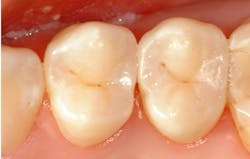 Figure 1: These two premolars don’t look diseased, but they have initial caries on three of the four interproximal surfaces. Tooth preparations with a small bur (#329), a minimal prep, a tight matrix (Garrison or other), disinfection (Microprime for two, one-minute applications), a good bonding agent (Scotchbond Universal or other), a great composite (Filtek Supreme Ultra or other), combined with the concepts listed in this article, can produce long-lasting esthetic restorations. Figure 1: These two premolars don’t look diseased, but they have initial caries on three of the four interproximal surfaces. Tooth preparations with a small bur (#329), a minimal prep, a tight matrix (Garrison or other), disinfection (Microprime for two, one-minute applications), a good bonding agent (Scotchbond Universal or other), a great composite (Filtek Supreme Ultra or other), combined with the concepts listed in this article, can produce long-lasting esthetic restorations.