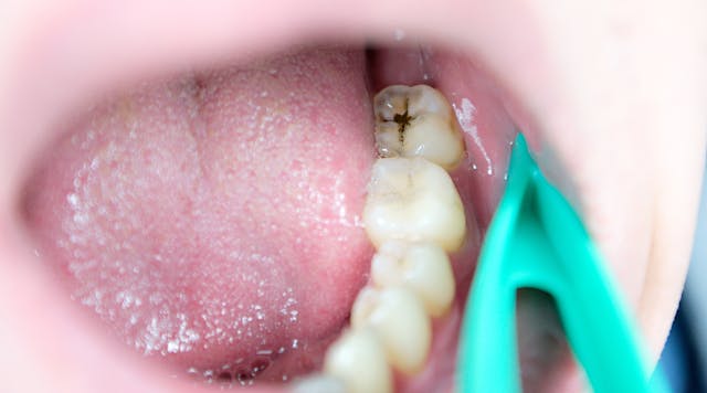 Dental decay is no longer a childhood problem; more and more American adults are experiencing this condition.