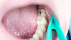 Dental decay is no longer a childhood problem; more and more American adults are experiencing this condition. Dental decay is no longer a childhood problem; more and more American adults are experiencing this condition.