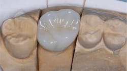 Figure 1: Zirconia crowns are strong and can be beautiful, but there are some peculiar clinical challenges associated with them (crowns coming off and caries reoccurring on margins), probably due to cements. Figure 1: Zirconia crowns are strong and can be beautiful, but there are some peculiar clinical challenges associated with them (crowns coming off and caries reoccurring on margins), probably due to cements.