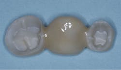Figure 2: Vertical grooves are cut by the dentist on the axial walls of the tooth preparation, and the result is shown in this zirconia fixed prosthesis. This well-known retentive procedure has been long-established from historical cast-gold restorations. Figure 2: Vertical grooves are cut by the dentist on the axial walls of the tooth preparation, and the result is shown in this zirconia fixed prosthesis. This well-known retentive procedure has been long-established from historical cast-gold restorations.