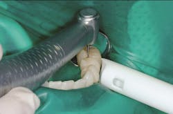 Figure 3: Use of an electric handpiece in an optimum clean and dry field can produce excellent restorations. Figure 3: Use of an electric handpiece in an optimum clean and dry field can produce excellent restorations.