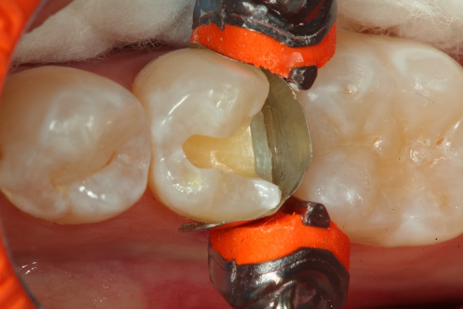 Figure 2: A sectional matrix is placed, and the tooth is isolated for restoration.
