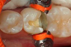 Figure 2: A sectional matrix is placed, and the tooth is isolated for restoration. Figure 2: A sectional matrix is placed, and the tooth is isolated for restoration.
