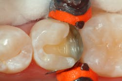 Figure 3: A thin layer of flowable composite is placed in the most apical portion of the proximal box. Figure 3: A thin layer of flowable composite is placed in the most apical portion of the proximal box.