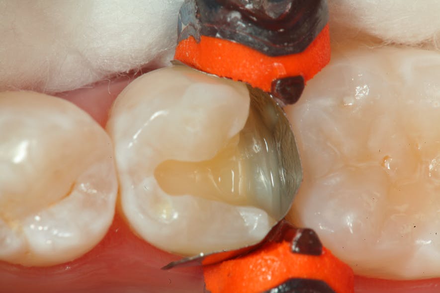 10 years of clinical success with composite resin technology: Case ...