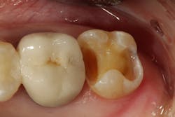 Figure 6: The final preparation after removal of deep decay Figure 6: The final preparation after removal of deep decay