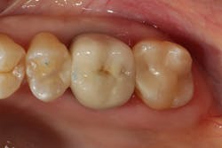 Figure 8: The immediate post-op photo of the final large class II restoration after occlusal adjustment and polishing Figure 8: The immediate post-op photo of the final large class II restoration after occlusal adjustment and polishing