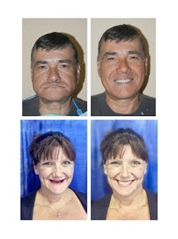 Figure 2: Before and after results using the Larell One Step Denture Figure 2: Before and after results using the Larell One Step Denture