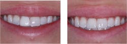Figure 1: One central incisor kept this patient from smiling. She was embarrassed to smile because when she did, she had the feeling that everyone focused on her off-colored crown. Replacing just one crown significantly improved this patient’s self-esteem. Figure 1: One central incisor kept this patient from smiling. She was embarrassed to smile because when she did, she had the feeling that everyone focused on her off-colored crown. Replacing just one crown significantly improved this patient’s self-esteem.