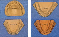 Figure 1: This image of the Kennedy classification of removable partial dentures shows the potential for adequate use of flexible removable partial dentures primarily for class III situations, because natural teeth can allow retention of the flexible material into undercuts for retention and cross-arch support of occlusion provided by natural teeth. Figure 1: This image of the Kennedy classification of removable partial dentures shows the potential for adequate use of flexible removable partial dentures primarily for class III situations, because natural teeth can allow retention of the flexible material into undercuts for retention and cross-arch support of occlusion provided by natural teeth.