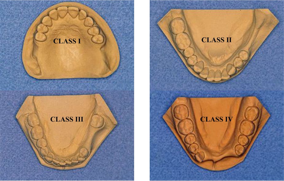 Figure 1: This image of the Kennedy classification of removable partial dentures shows the potential for adequate use of flexible removable partial dentures primarily for class III situations, because natural teeth can allow retention of the flexible material into undercuts for retention and cross-arch support of occlusion provided by natural teeth.