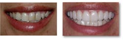 Figure 2: This potentially attractive smile with discolored and malposed teeth was not achieving its potential until some ceramic veneers made a fantastic difference in how this young lady felt about herself. Figure 2: This potentially attractive smile with discolored and malposed teeth was not achieving its potential until some ceramic veneers made a fantastic difference in how this young lady felt about herself.