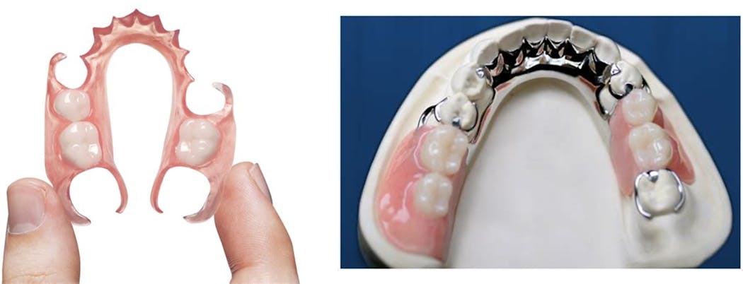 Figure 2: Although flexible removable partial dentures are popular and liked by patients, the stability, retention, and long-term success of properly made metal-supported partials should be considered for many clinical situations.