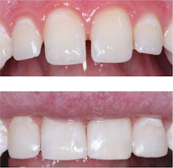 Figure 3: Why place ceramic crowns or veneers when results with resin such as this can serve inexpensively for many years? Figure 3: Why place ceramic crowns or veneers when results with resin such as this can serve inexpensively for many years?