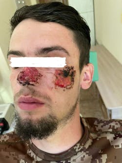 Dr. Olena Kulibaba’s patient two weeks after injury, a day before a surgery, after necrosis treatment. Dr. Olena Kulibaba’s patient two weeks after injury, a day before a surgery, after necrosis treatment.