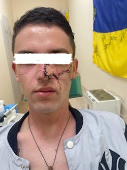 Dr. Olena Kulibaba’s patient a week after surgery. Dr. Olena Kulibaba’s patient a week after surgery.