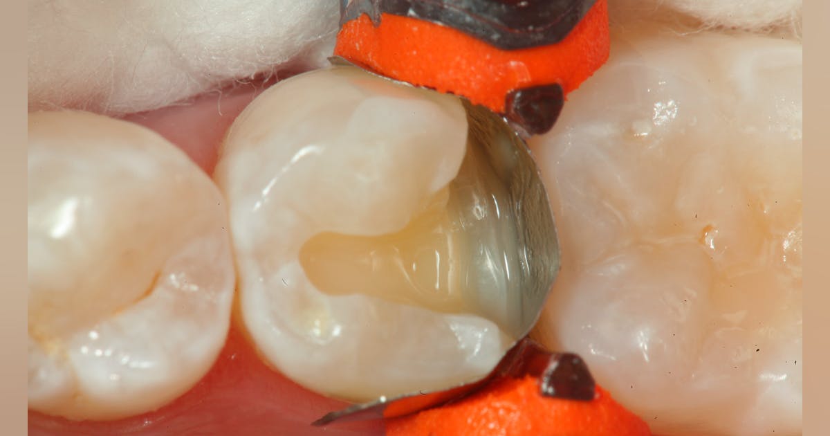 Dentist Composite Technique at Peggy Bradley blog
