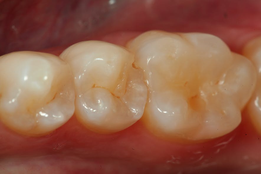 Figure 1: Second premolar present with distal decay and fracture of distal marginal ridge