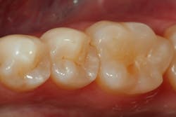 Figure 1: Second premolar present with distal decay and fracture of distal marginal ridge Figure 1: Second premolar present with distal decay and fracture of distal marginal ridge