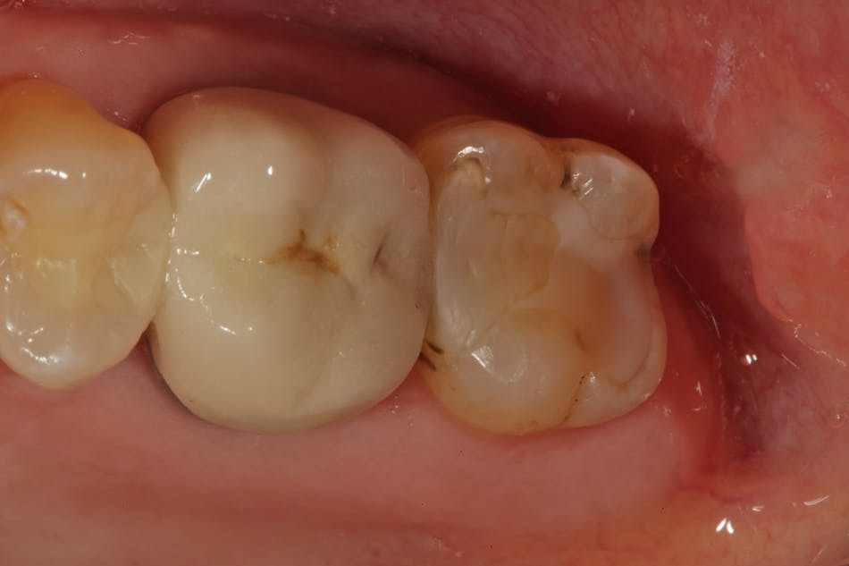 Figure 5: An upper second molar presents with a large, old restoration with radiographic recurrent decay on the mesial.