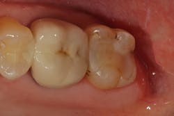 Figure 5: An upper second molar presents with a large, old restoration with radiographic recurrent decay on the mesial. Figure 5: An upper second molar presents with a large, old restoration with radiographic recurrent decay on the mesial.
