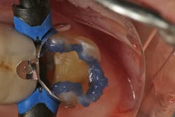 Figure 7: A selective-etch technique is used prior to placement of the universal bonding agent. Figure 7: A selective-etch technique is used prior to placement of the universal bonding agent.