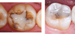 Figure 1: Failing composites are nothing new to experienced dentists. What can be done to reduce or eliminate such failures?