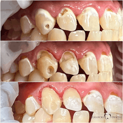 Figure 2: Nos. 6 and 7 are facial carious lesions. Caries were removed with the Solea laser at 40% power, 9 mL mist, medium air, and 1.25 mm spot size. The gingivectomy was performed by reducing the power to 20%, resulting in zero to minimal bleeding. The teeth were restored with Ivoclar Adhese and Tetric Prime Flow. Photos were taken before, during, and immediately after completion. Figure 2: Nos. 6 and 7 are facial carious lesions. Caries were removed with the Solea laser at 40% power, 9 mL mist, medium air, and 1.25 mm spot size. The gingivectomy was performed by reducing the power to 20%, resulting in zero to minimal bleeding. The teeth were restored with Ivoclar Adhese and Tetric Prime Flow. Photos were taken before, during, and immediately after completion.
